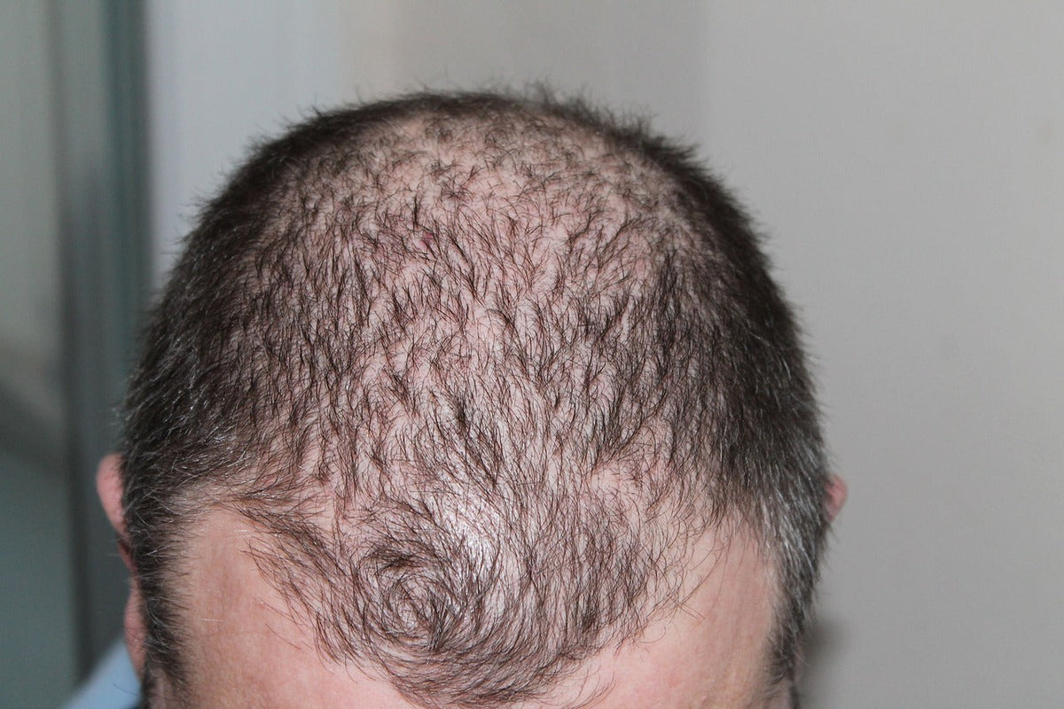 Was tun bei Haarausfall nach Cortison