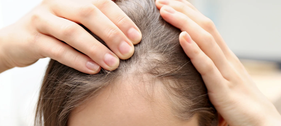 Geheimratsecken bei Frauen und was man gegen sie tun kann