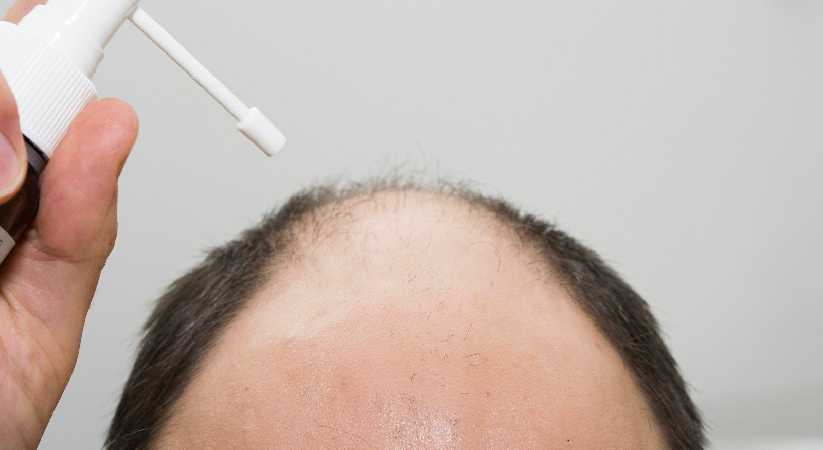 Hausmittel gegen Haarausfall