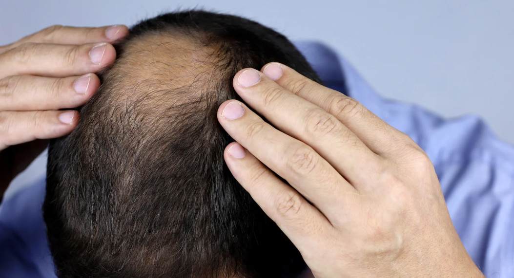 Haarausfall erkennen