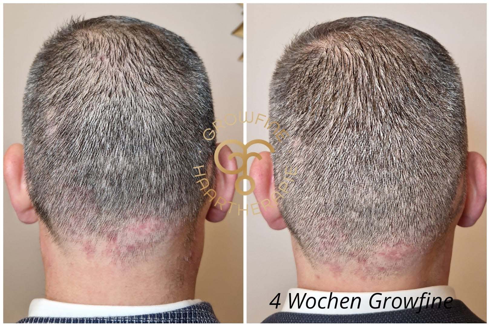 Shampoo gegen Haarausfall Vorher-Nachher Vergleich