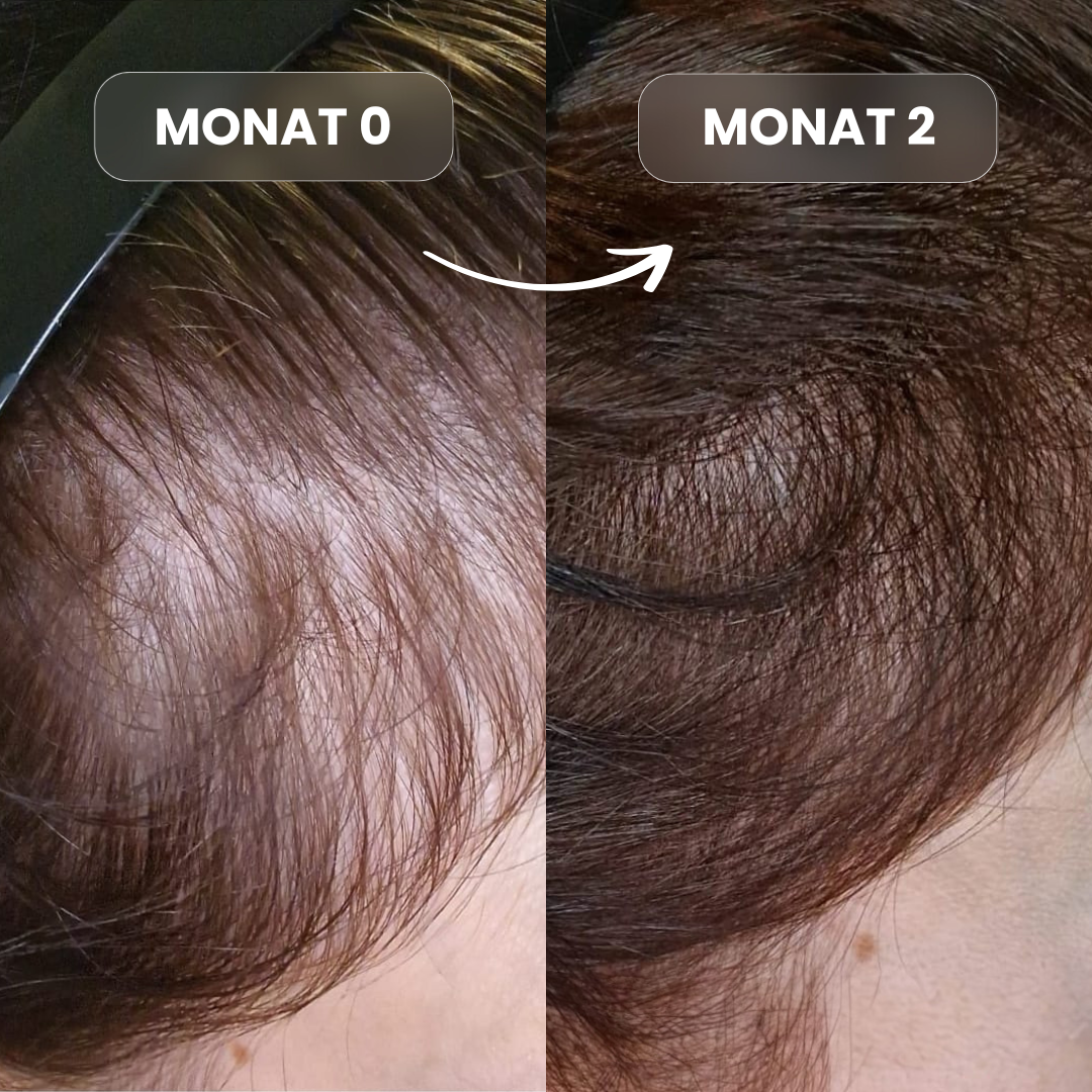 sägepalme haarausfall vorher nachher
